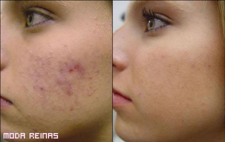 acne-disimulado-con-base-de-maquillaje